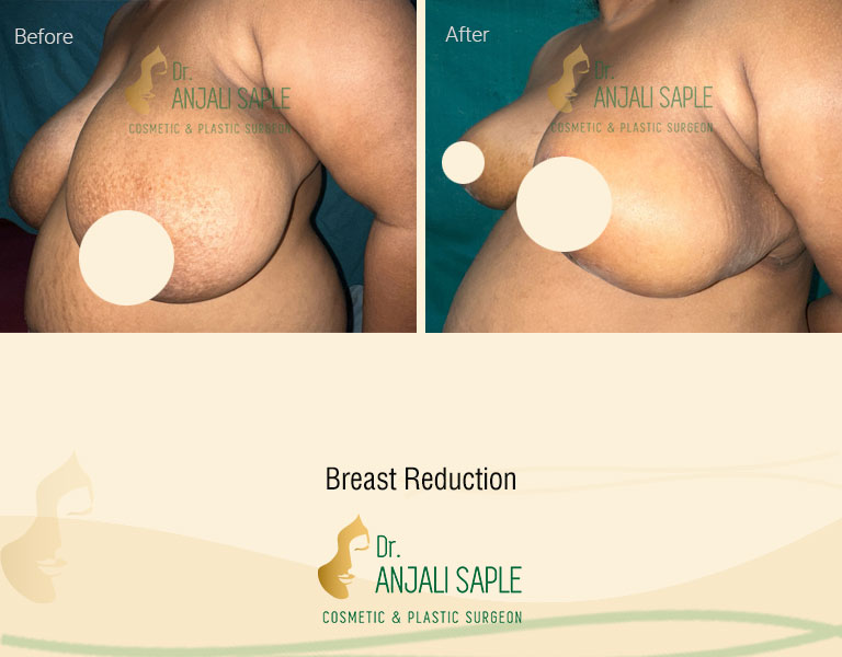 Side view of before and after image for breast reduction surgery