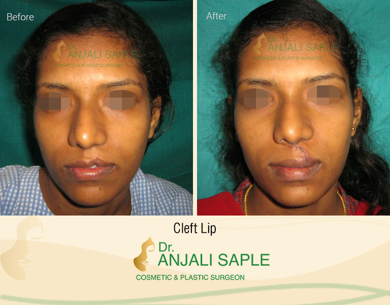 Cleft Lip and Palate Surgery Bottom View
