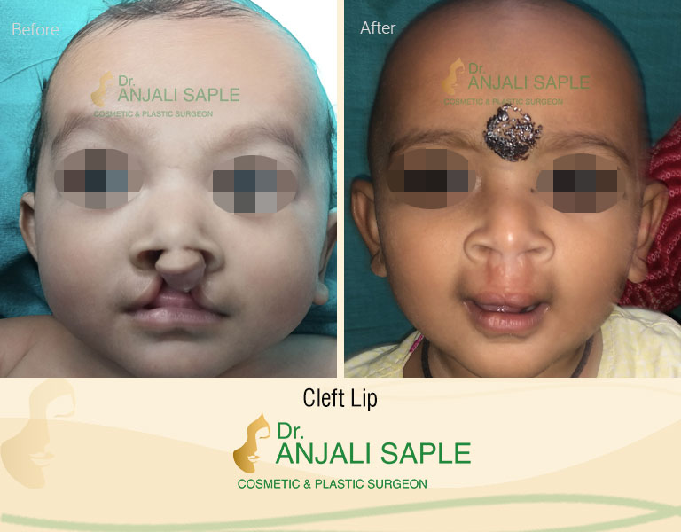 Cleft Lip and Palate Surgery Front View