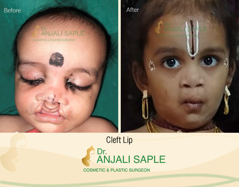 Case 1: Cleft Lip and Palate Surgery