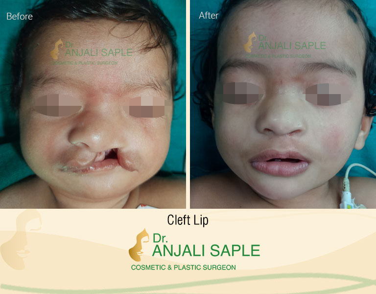 Case 2: Cleft Lip and Palate Surgery