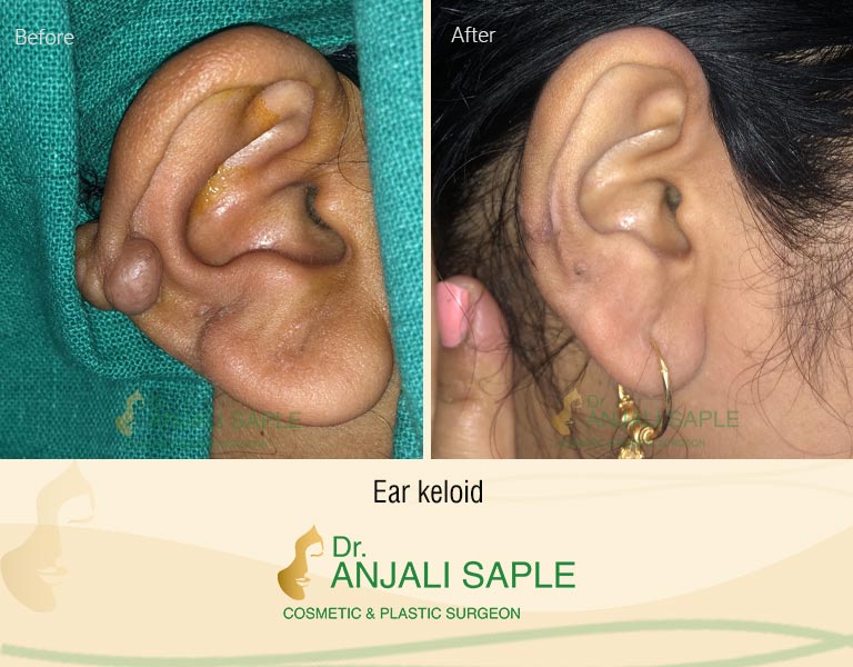 Ear keloid Right Side View