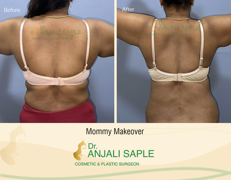 Mommy Makeover Back View Abdomen Liposuction