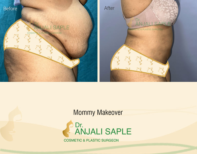 Mommy Makeover Surgery by Dr. Anjali Saple Right-Side-view