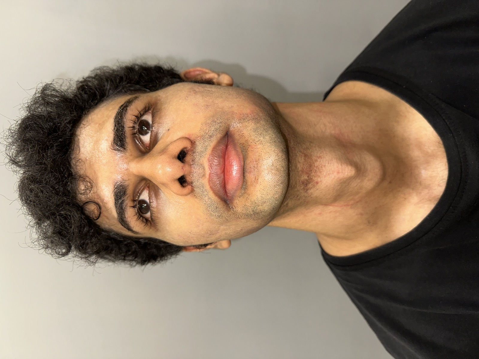 Saket after rhinoplasty - base view showing a more symmetric nasal base following septal correction and turbinate reduction