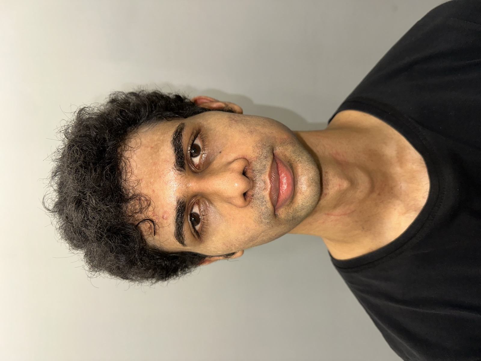 Saket after rhinoplasty - front view showing a straighter, more defined nasal midline