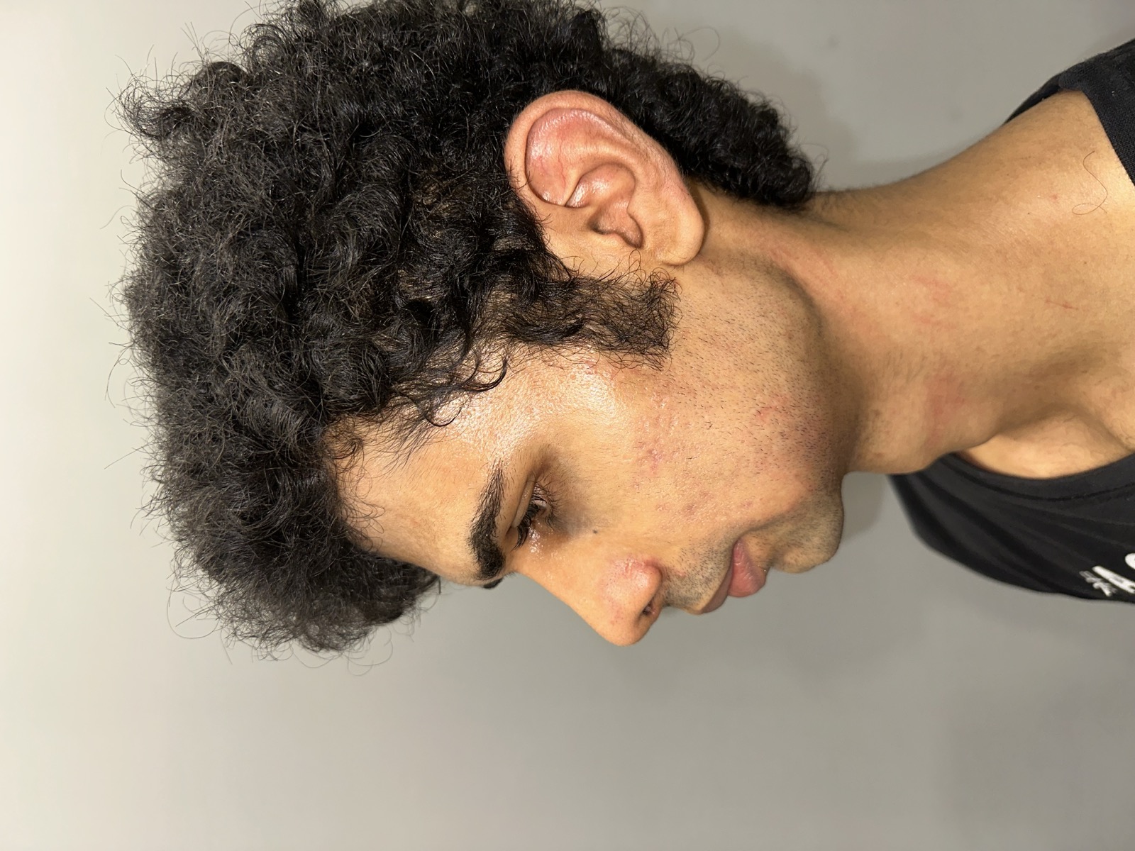 Saket after rhinoplasty - left profile view showing a sharper nasal dorsum and refined tip