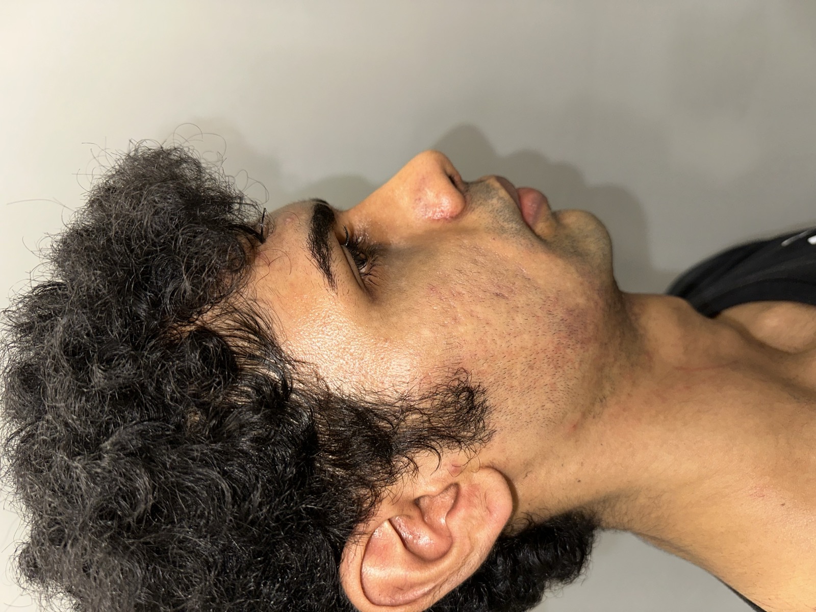 Saket after rhinoplasty - right profile view showing a sharper nasal dorsum and tip