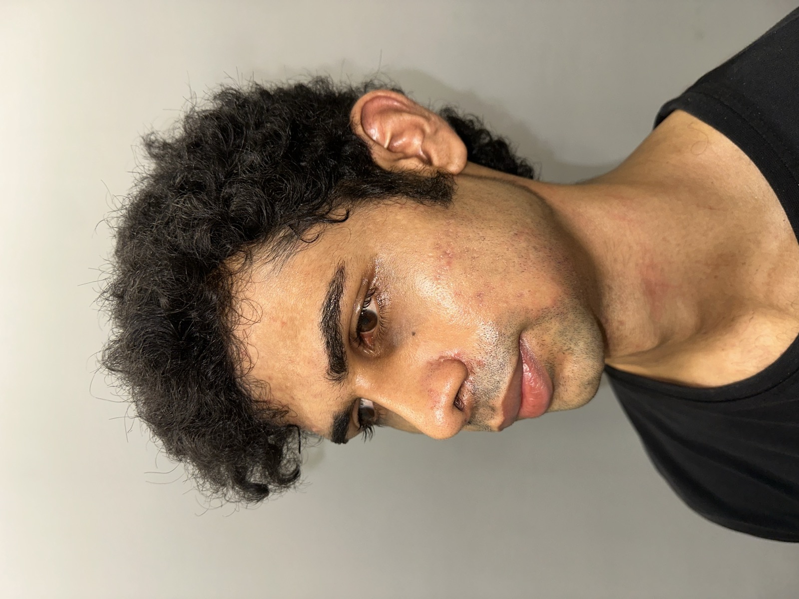 Saket after rhinoplasty - left three-quarter view showing the refined bridge and tip