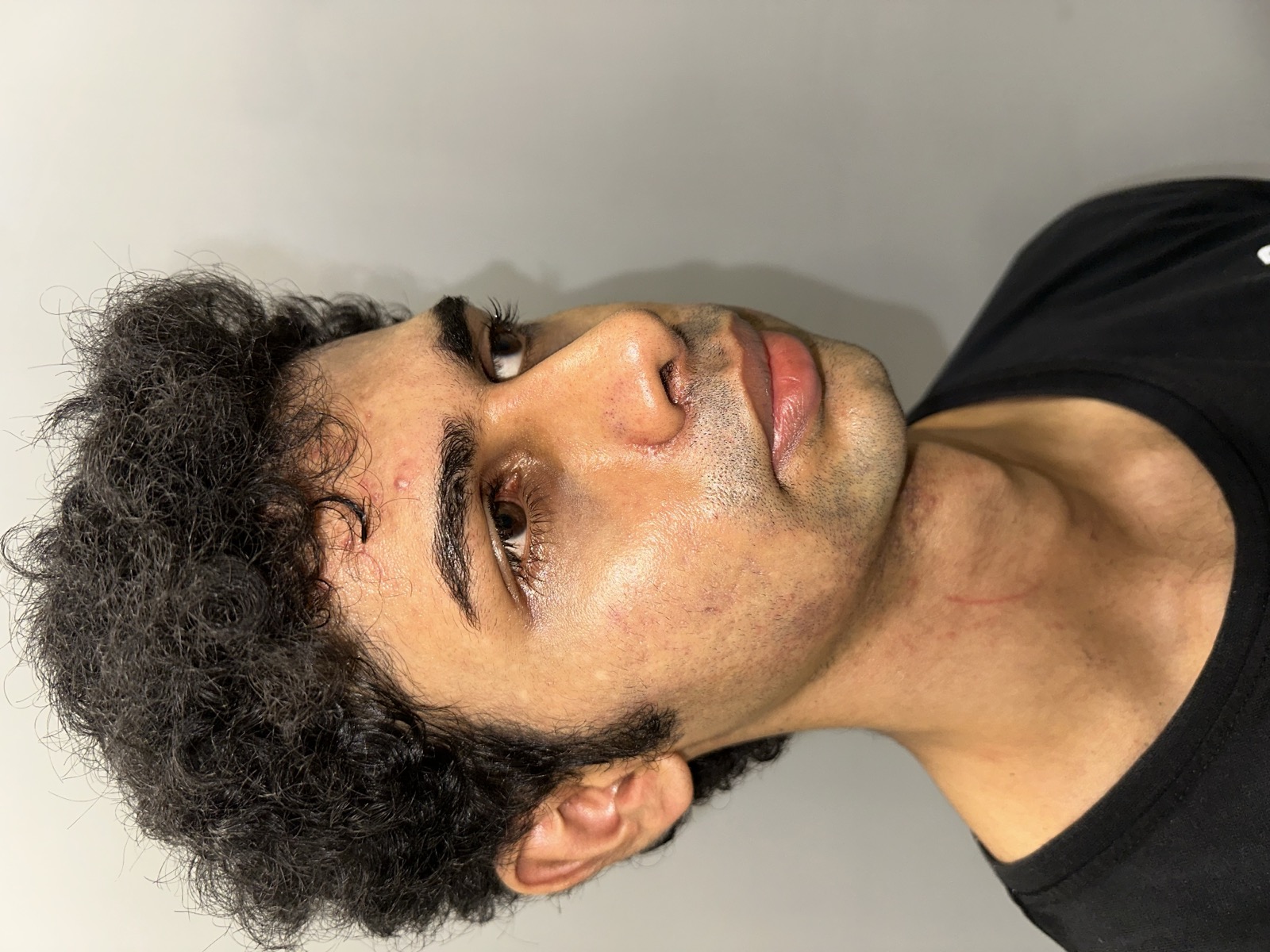 Saket after rhinoplasty - right three-quarter view showing the refined bridge and tip
