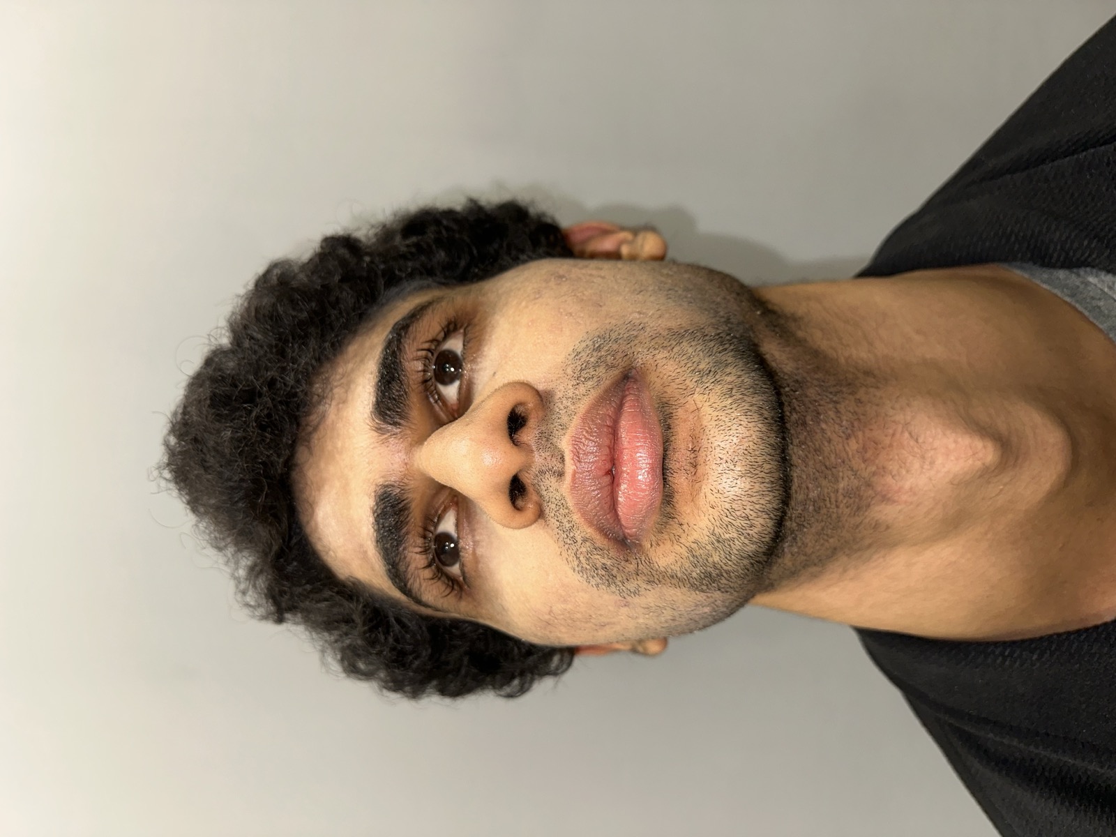 Saket before rhinoplasty - base view showing nostril asymmetry associated with the deviated septum