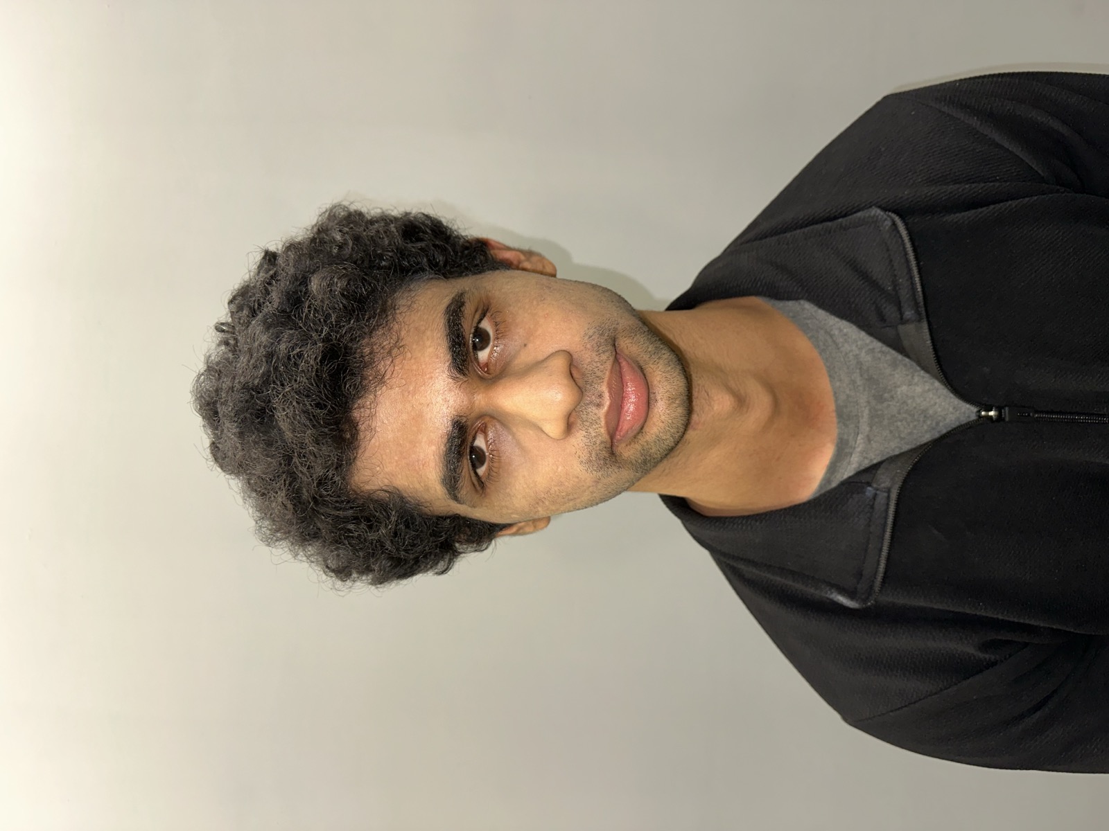 Saket before rhinoplasty - front view showing nasal midline and tip definition