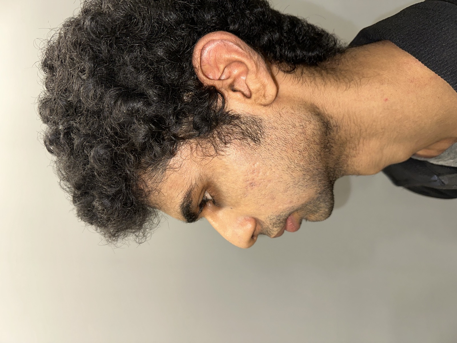 Saket before rhinoplasty - left profile view showing the nasal dorsum and tip projection