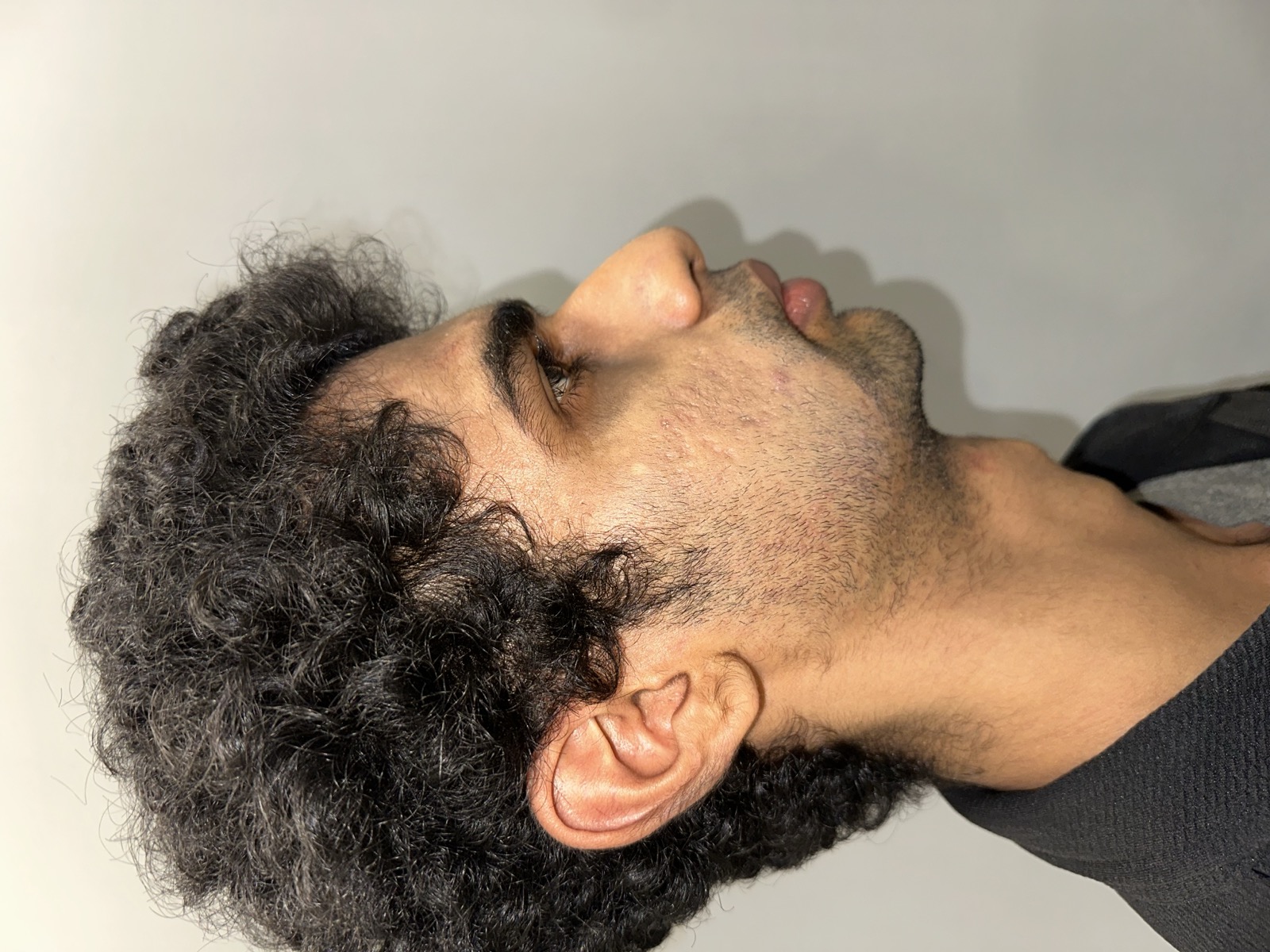 Saket before rhinoplasty - right profile view showing the nasal dorsum and tip projection