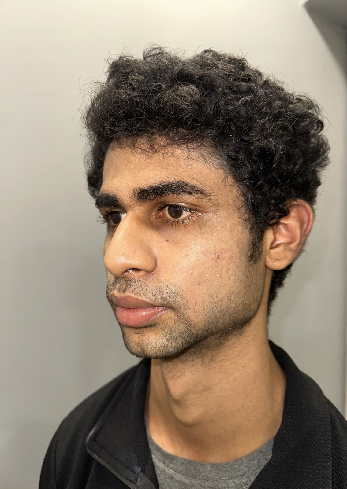 Saket before rhinoplasty - left three-quarter view showing nasal bridge and tip contour