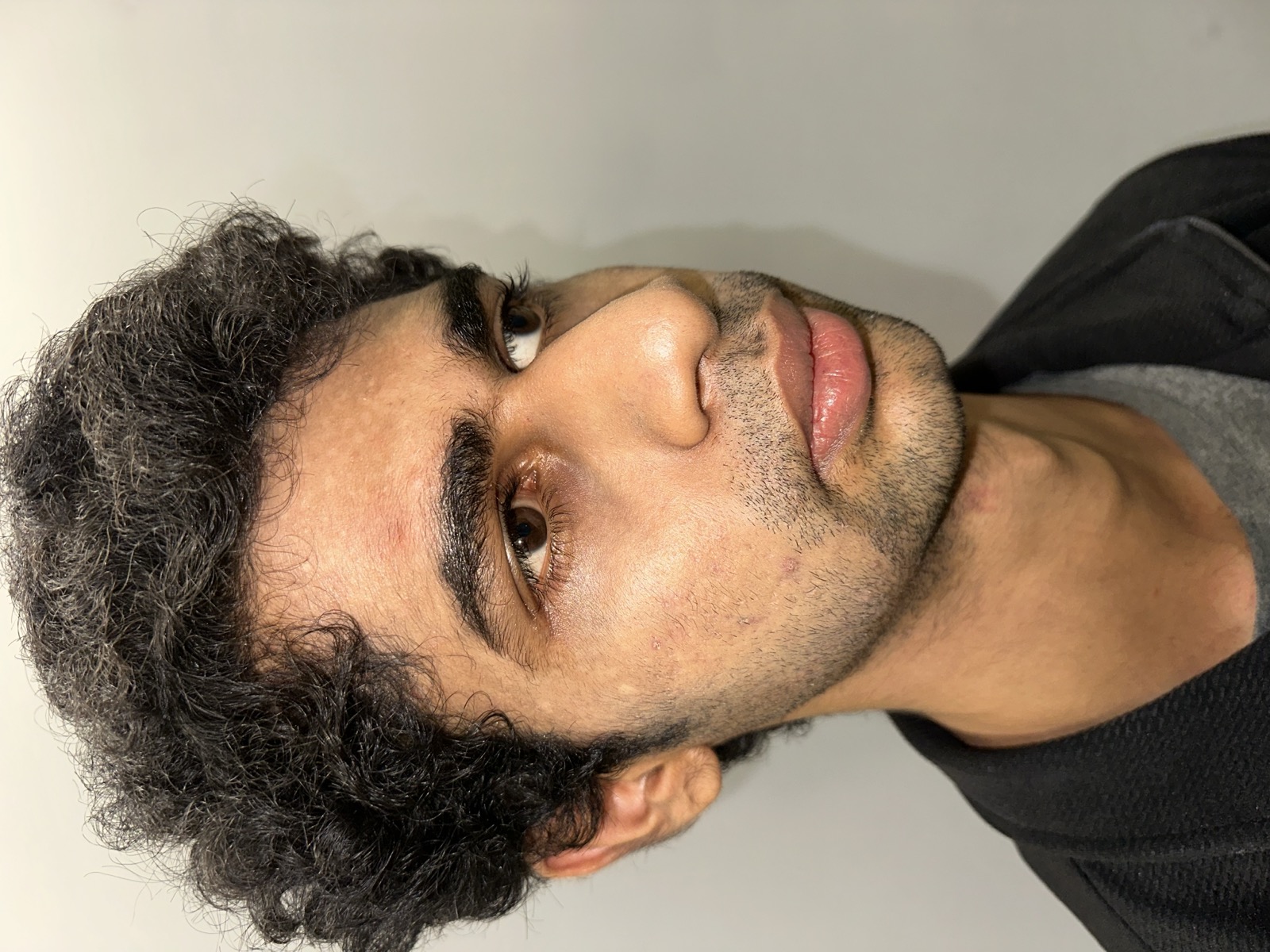 Saket before rhinoplasty - right three-quarter view showing nasal bridge and tip contour