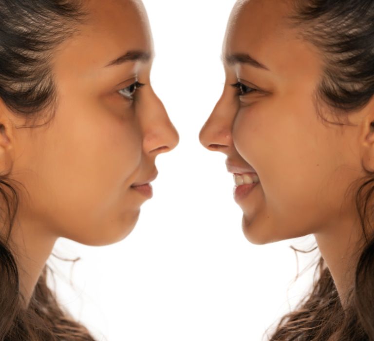 saddle-nose
