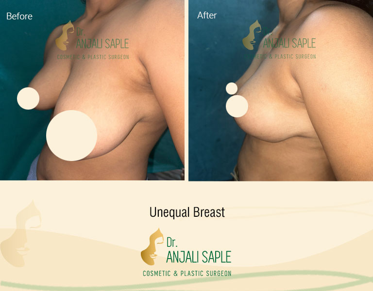 Unequal Breast Left side view