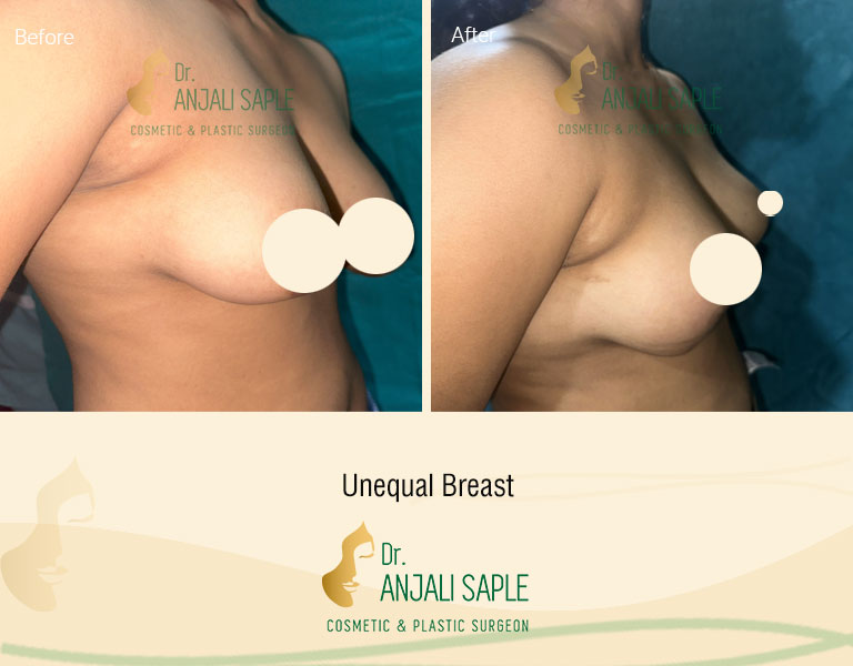 Unequal Breast Right side view