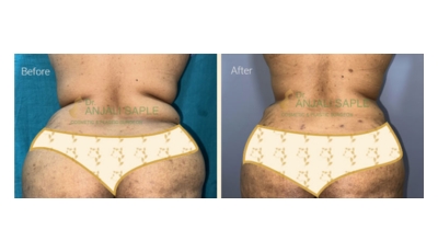 Case 1: Liposuction Back View